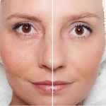 blandford-cosmetic-clinic-ipl-skin-rejuvenation