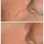 blandford-cosmetic-clinic-broken-capillary-ipl
